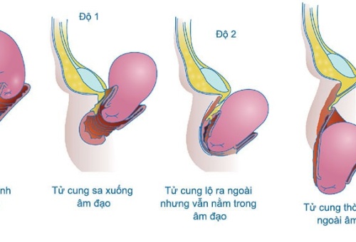 Thật hạnh phúc khi không còn những cơn đau căng tức vùng bụng dưới vì sa tử cung